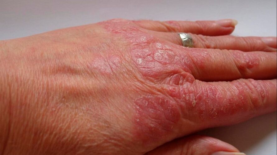 sintomi della psoriasi alle mani