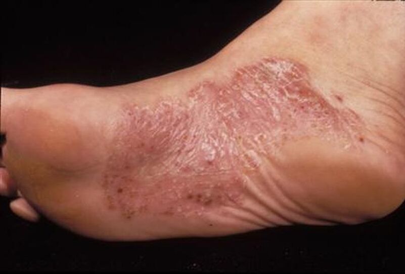 sintomi di psoriasi al piede
