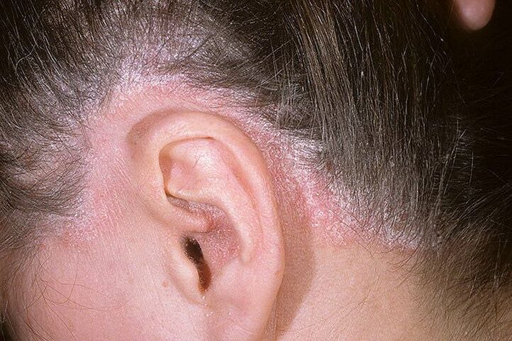 Eruzioni di psoriasi sulla testa dietro le orecchie