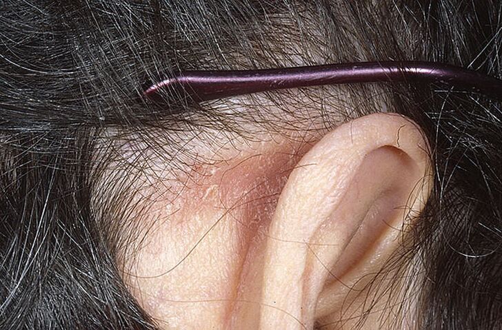 Placca psoriasica dietro l'orecchio