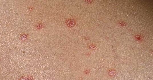 Placche psoriatiche