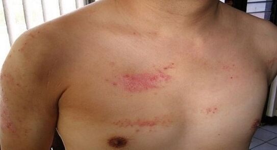 Psoriasi nella zona del torace