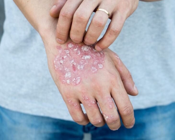 Psoriasi nelle mani