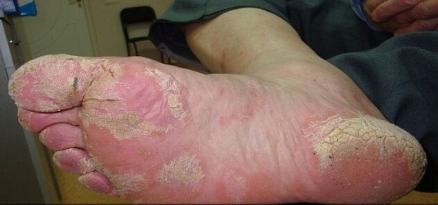 Psoriasi sulle gambe