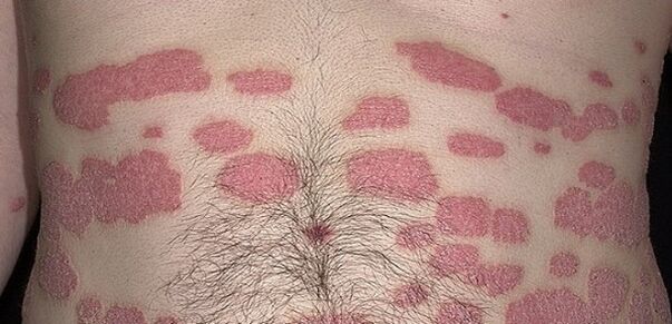 Psoriasi