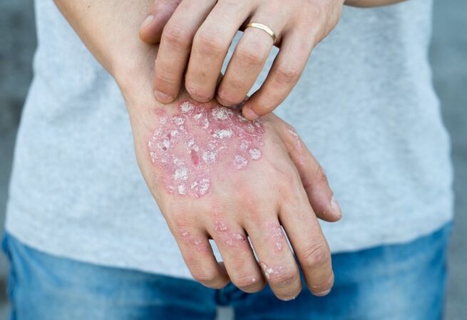 Psoriasi mesnicherata