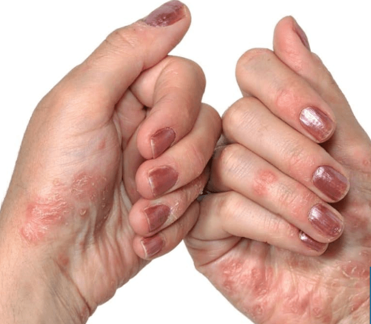 Psoriasi nelle mani
