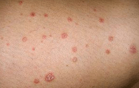 Placche psoriatiche