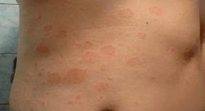 Psoriasi sfortunata