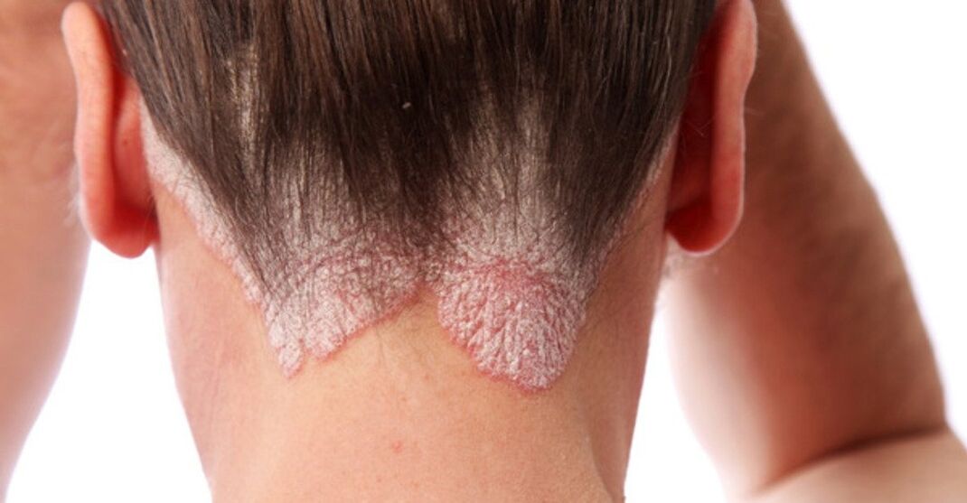 Psoriasi sulla testa delle ragazze