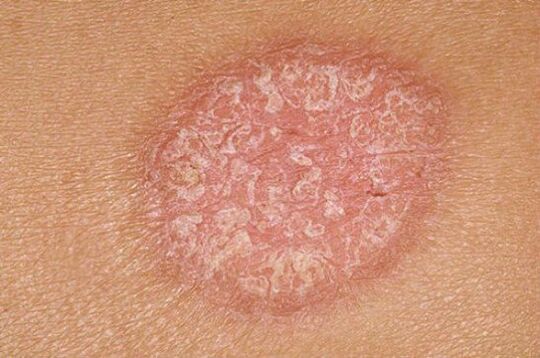 psoriasi