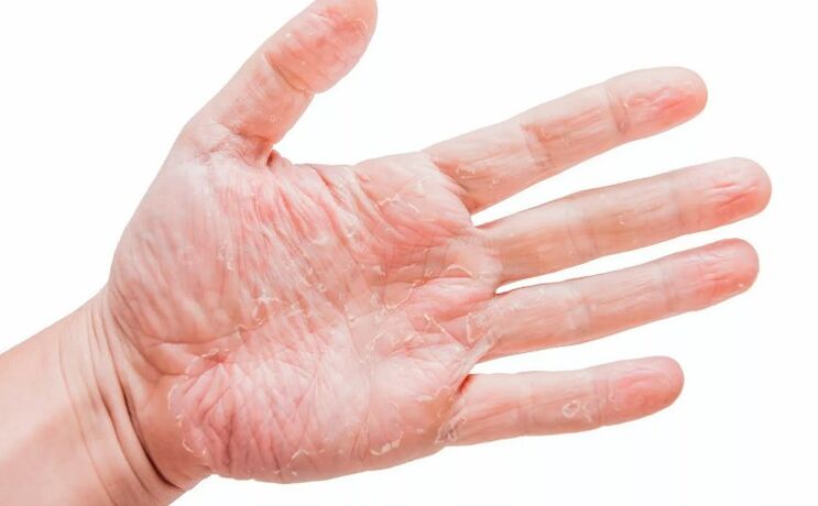 Psoriasi