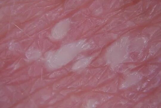 Pustulenia psoriasi