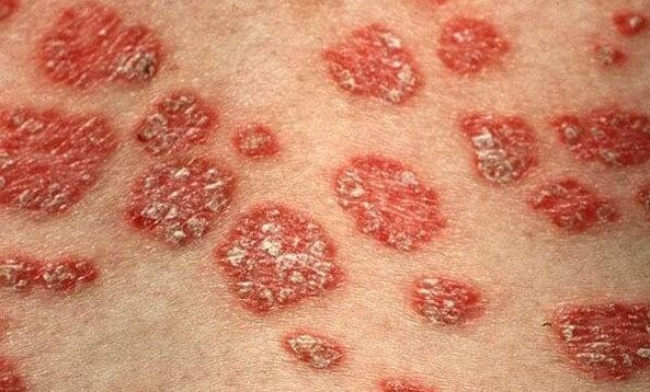 Forme di psoriasi