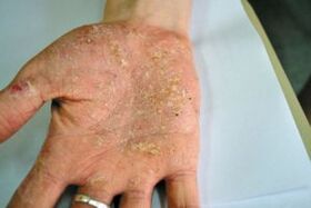 Psoriasi nel palmo della tua mano
