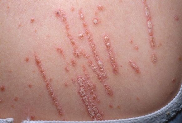 Psoriasi sul corpo