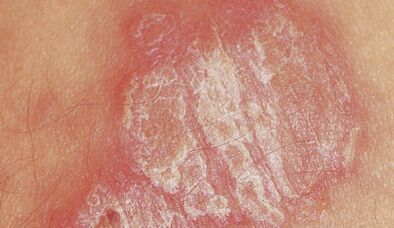 psoriasi