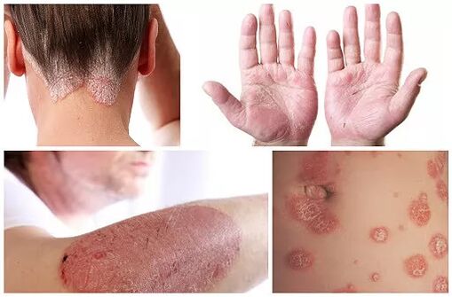 Manifestazioni di psoriasi in diverse parti del corpo