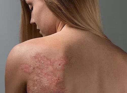Psoriasi sulla schiena di una ragazza