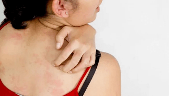 psoriasi