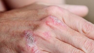 sintomi della fase iniziale della psoriasi