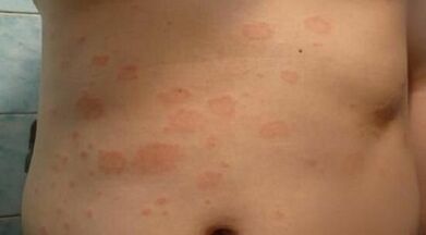 come riconoscere lo stadio iniziale della psoriasi