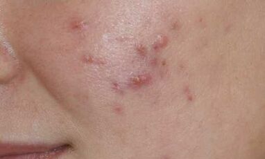 sintomi della fase iniziale della psoriasi