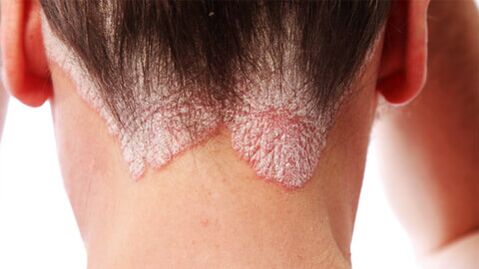 Placche psoriasiche sul cuoio capelluto