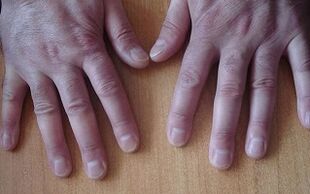 sintomi della psoriasi nella fase iniziale