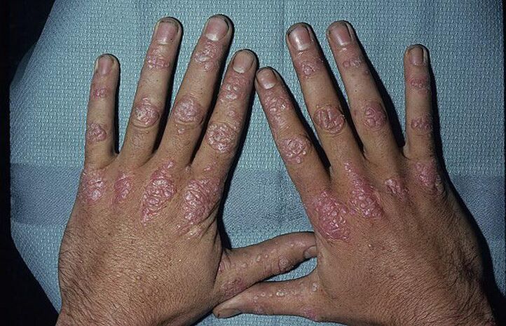 ragioni per lo sviluppo della psoriasi sulle mani