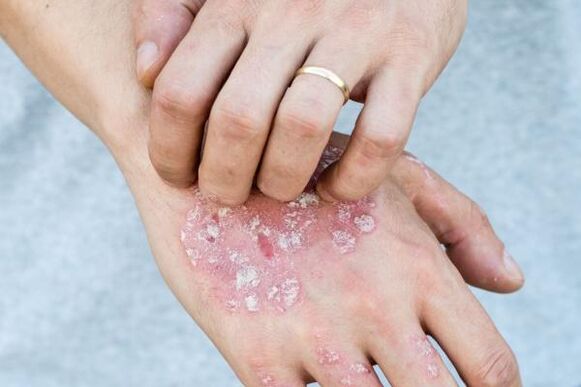 sintomi caratteristici della psoriasi sulle mani