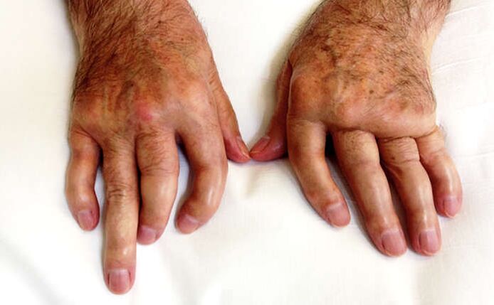 Artrite mutilante nella psoriasi