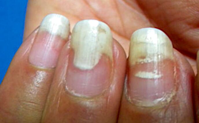 Onicolisi e leuconichia dopo la manicure
