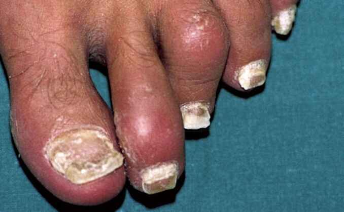Psoriasi con coinvolgimento delle unghie e infiammazione articolare (artrite) delle dita dei piedi
